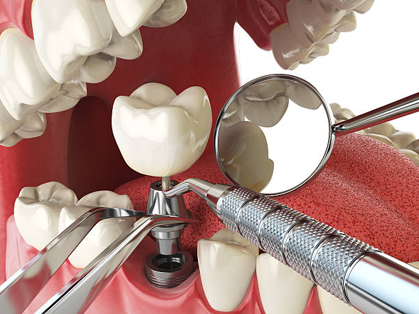 Best Emergency Dental Extractions in Freeburg, IL